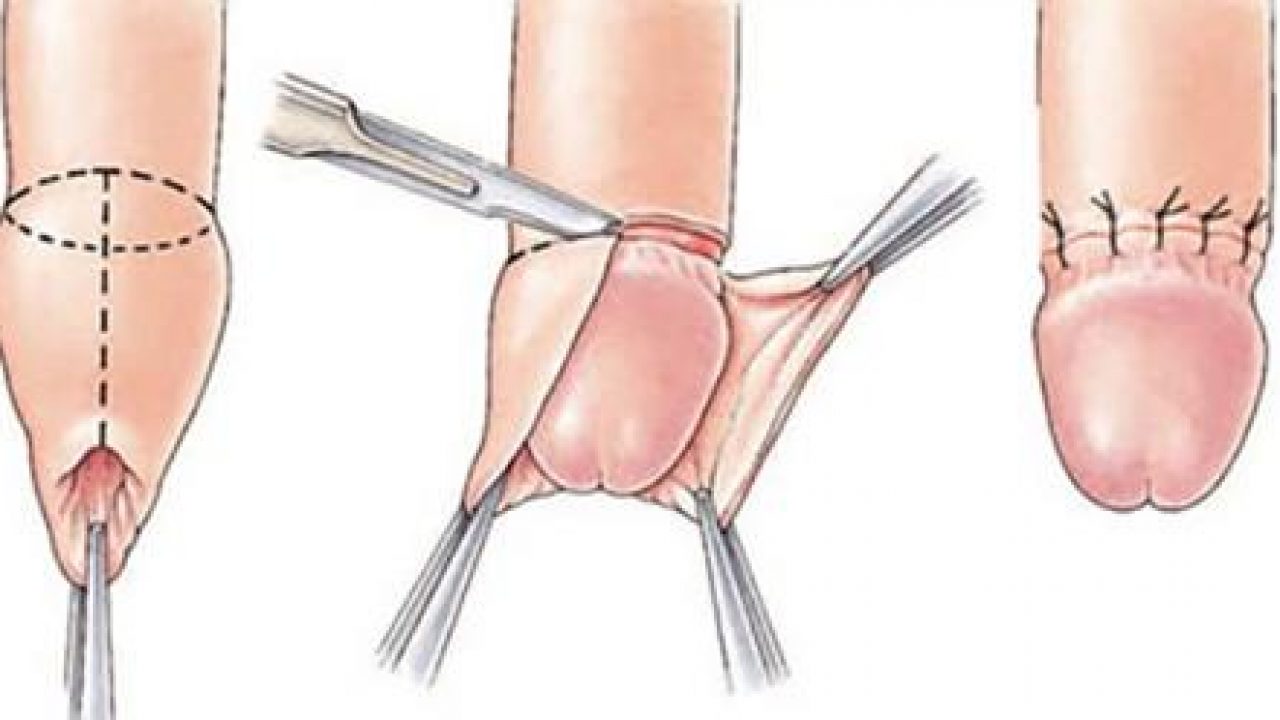 Por qué es buena la circuncisión? | UDU - Unidad de Urología