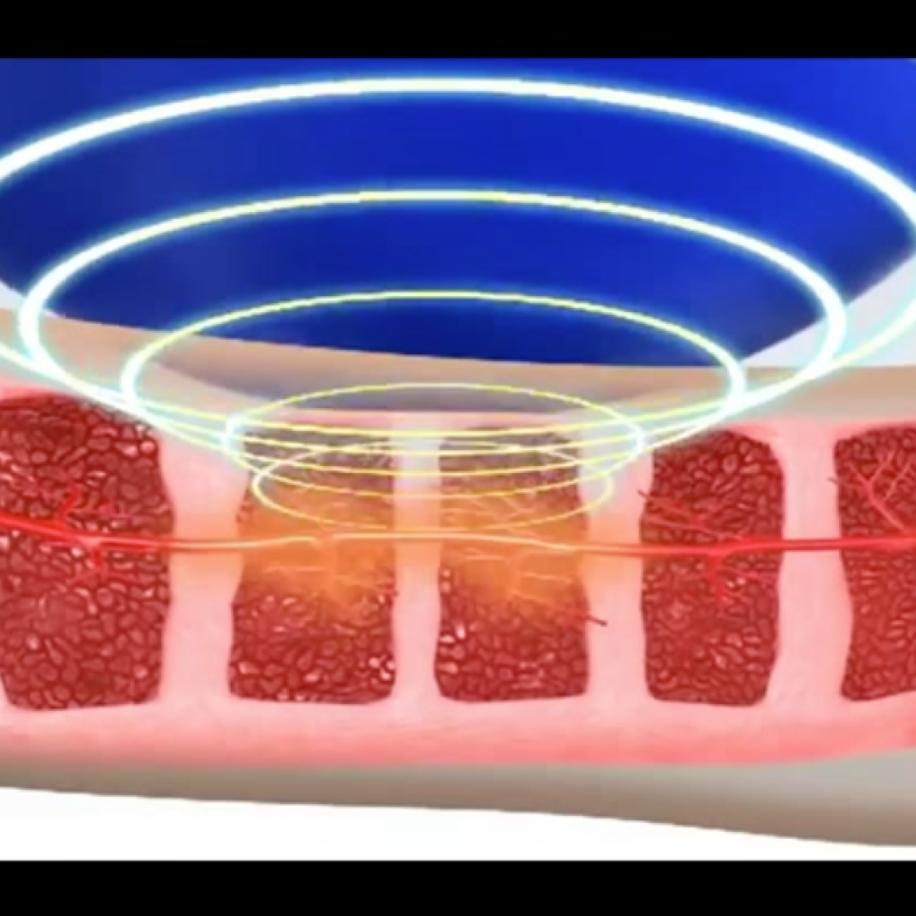tratamiento para la erección en Tijuana