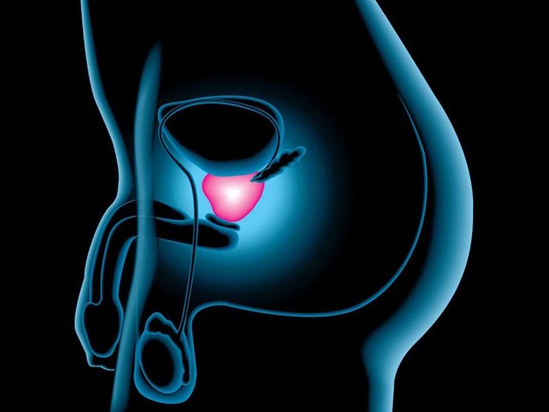 He sido diagnosticado con cáncer de próstata ¿qué hago?