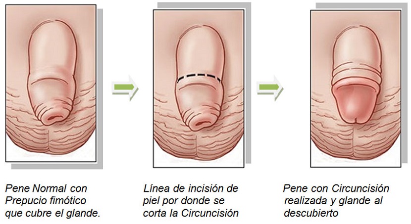 Cuidados previos y posteriores a una circuncisión