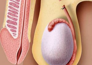 Vasectomia Reversible