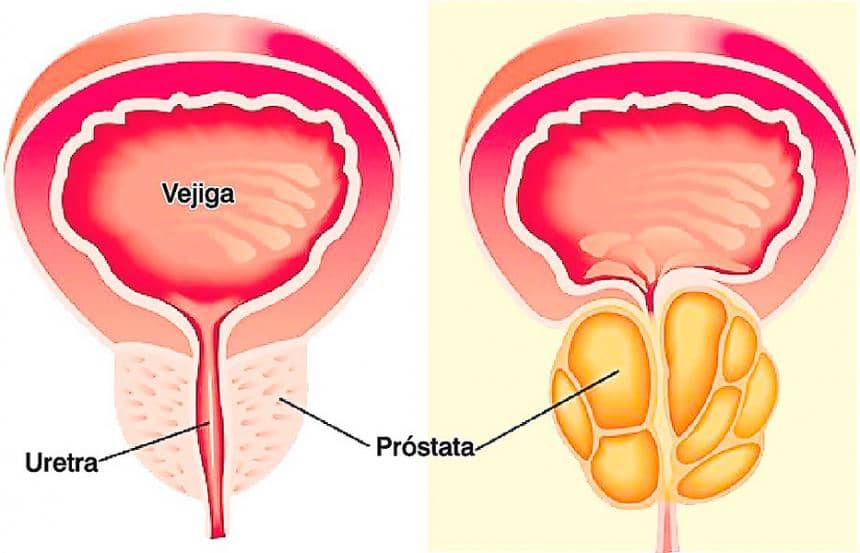 Síntomas del cáncer de próstata