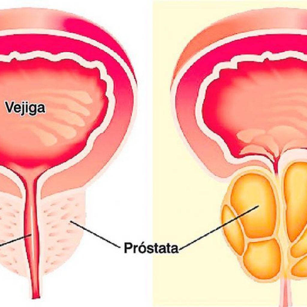 cancer de prostata