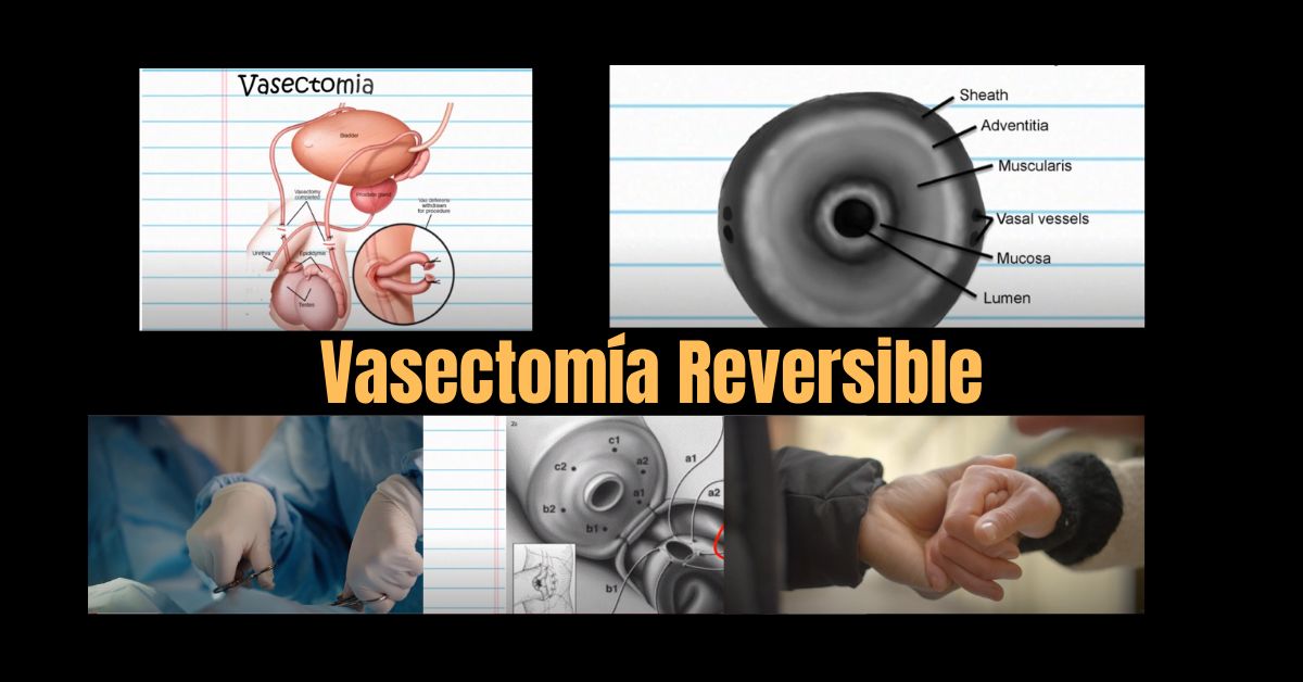 Blog 1 vasectomía reversible