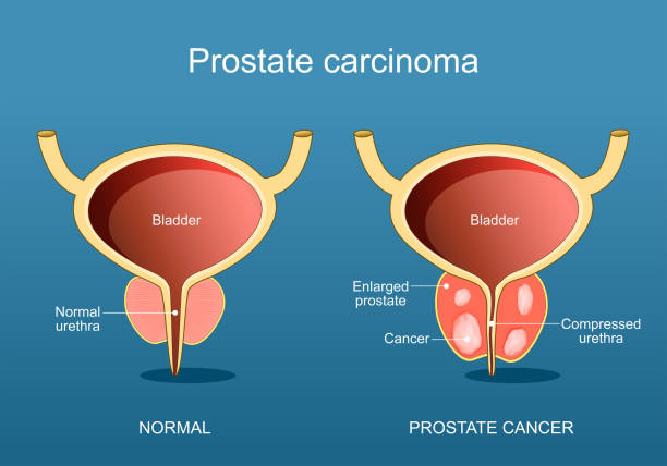 tratamiento para el cáncer de próstata en Tijuana