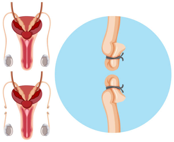 vasectomía reversible