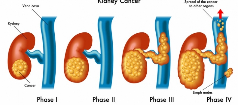 Lo que debes conocer acerca del cáncer de riñón