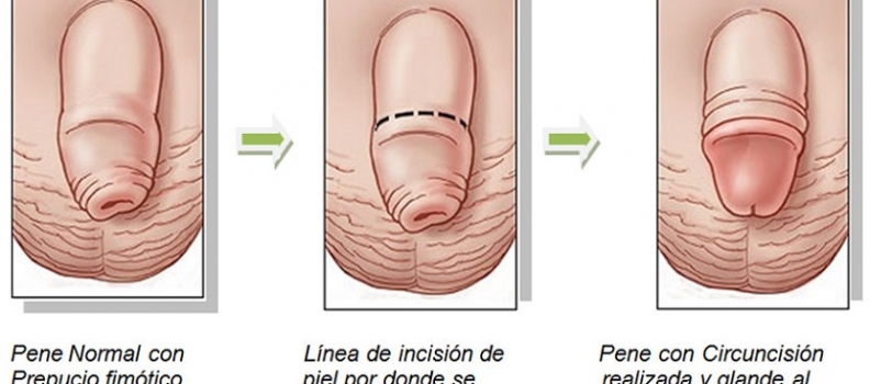 Cuidados previos y posteriores a una circuncisión