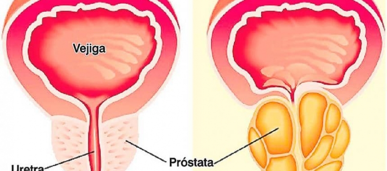 Síntomas del cáncer de próstata