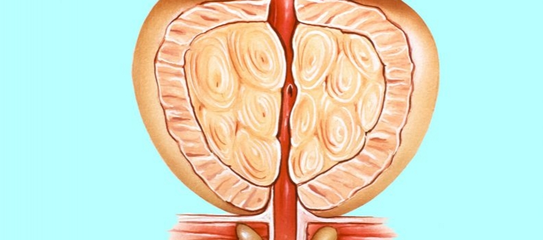 ¿Cómo detectar el cáncer de próstata cuando no presenta síntomas?